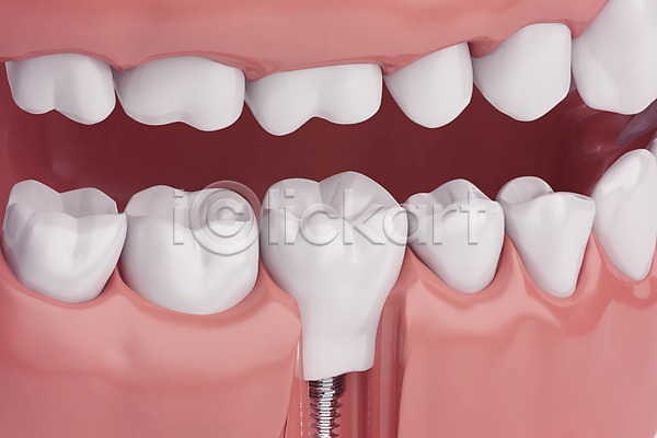 사람없음 3D PSD 디지털합성 편집이미지 3D소스 나사못 임플란트 잇몸 치과 치아 치아건강 치아모형 합성
