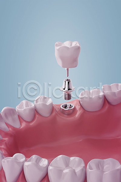 사람없음 3D PSD 디지털합성 편집이미지 3D소스 나사못 임플란트 잇몸 치과 치아 치아건강 치아모형 합성