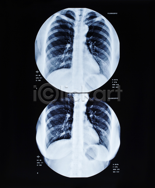 고통 사람 사람없음 JPG 포토 해외이미지 갈비뼈 건강 골격 광선 궤 기계 방사선 병원 뼈 시험 신체 어깨 엑스레이 필름 하트 해부 환자