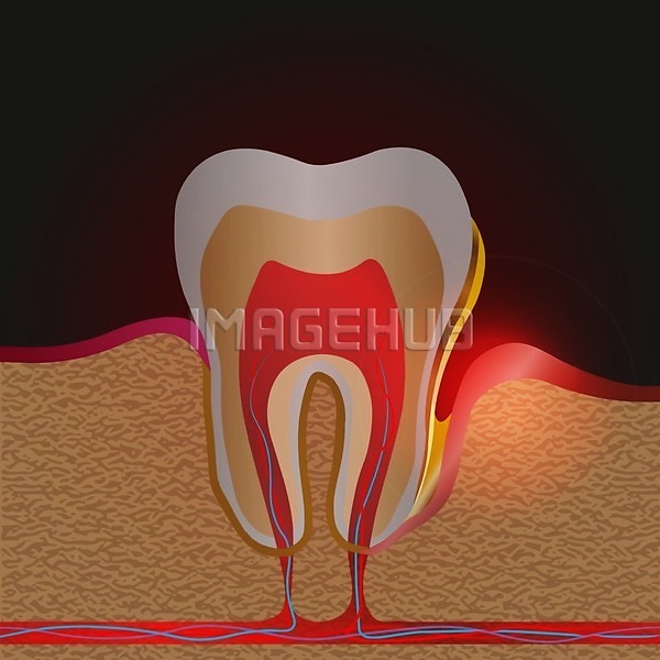 고통 사람 EPS 일러스트 해외이미지 감염 건강 고립 과학 구멍 돌봄 명패 문제 부분 뿌리 썩음 약 왕관 운하 위생관리 입 잇몸 질병 치과 치과의사 치료 치아 해부