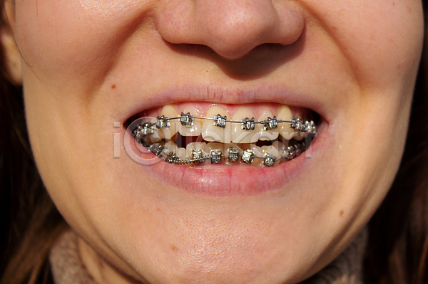신체부위 JPG 포토 해외이미지 교정기 미소(표정) 위생관리 입 치과 치아 치아건강 치아교정