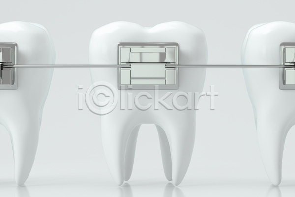 사람없음 3D JPG 해외이미지 교정기 연결 의학 치아 치아건강 치아관리 치아교정 흰색