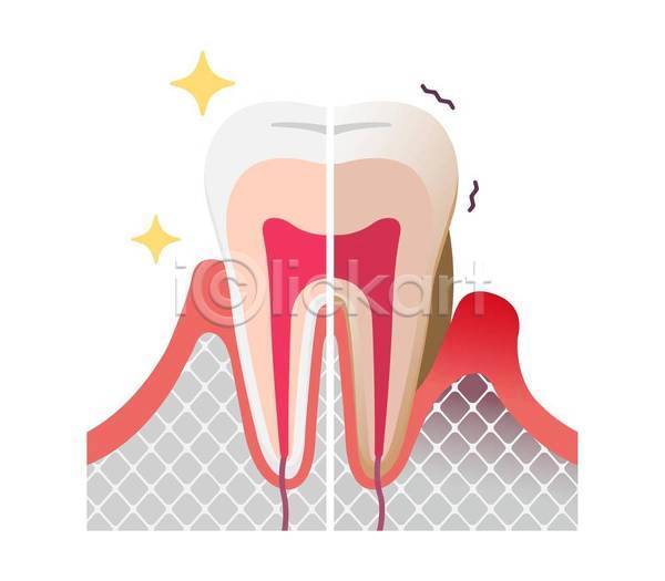 깨끗함 비교 지저분함 사람없음 EPS 일러스트 해외이미지 의학 잇몸 질병 치아 치아건강 치아관리