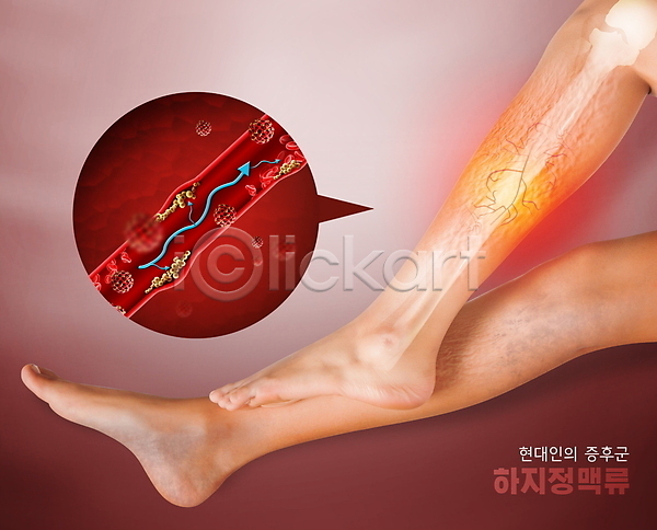 고통 신체부위 PSD 편집이미지 다리(신체부위) 다리뼈 빨간색 증후군 하반신 하지정맥류 혈관 혈관질환 혈액순환