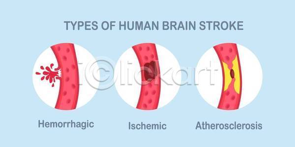 사람없음 EPS 일러스트 해외이미지 건강 건강관리 뇌졸중 뇌질환 뇌출혈 뇌혈관 동맥경화 의학 하늘색 혈관 혈관질환