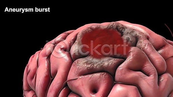 사람없음 3D JPG 포토 해외이미지 뇌 뇌졸중 뇌출혈 생명과학 생물학 손상 신경기관 질병 해외202309