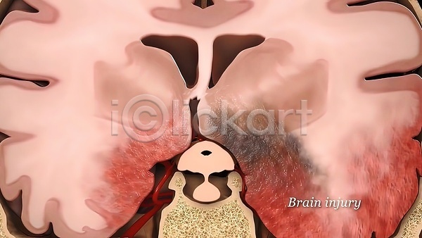 사람없음 3D JPG 포토 해외이미지 뇌 뇌종양 뇌출혈 생명과학 생물학 손상 신경기관 해외202309