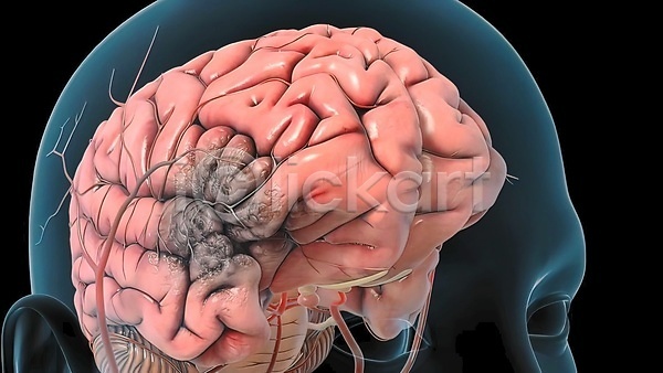 사람없음 3D JPG 포토 해외이미지 뇌 뇌졸중 뇌출혈 무료이미지 손상 질병 해외202310