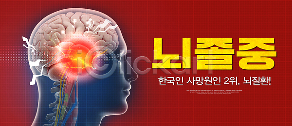 고통 PSD 편집이미지 뇌졸중 뇌질환 뇌혈관 실험 예방 의학 이미지편집 증상 치료 한국 혈관