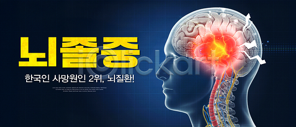 위험 PSD 편집이미지 건강 경고 관리 교육 뇌 뇌졸중 예방 이미지편집 질병 치료 통계 한국