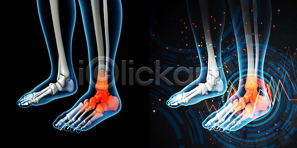 고통 사람 사람없음 JPG 포토 해외이미지 건강관리 관절염 발가락 발목 신체 엑스레이 염증 외과 정형외과 증상 치료 해부 해외202004 해외포토
