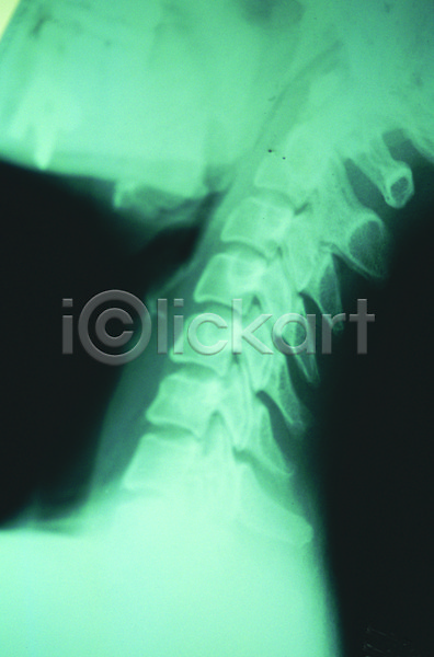 사람없음 JPG 포토 기구 도구 목 목뼈 방사선 병원 뼈 신체 엑스레이 영상 척추 치료 투시
