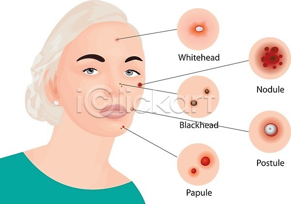 성인 성인여자한명만 한명 EPS 일러스트 해외이미지 뷰티 블랙헤드 상반신 얼굴 여드름 인포그래픽 정보 종류 피부관리 피부병 피부질환 해외202004 해외202105 화이트헤드