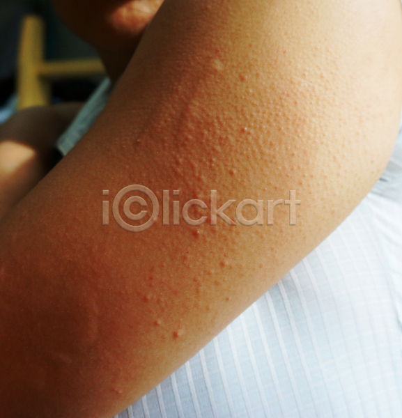 건조 사람 사람없음 JPG 포토 해외이미지 건강 반응 빨간색 알레르기 점 질병 팔 피부 해외202004 환자