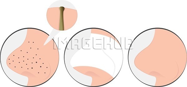 EPS 일러스트 해외이미지 가면 건강 검은색 돌봄 문제 사춘기 스파 얼굴 여드름 염증 오픈 위생관리 전후 점 질병 치료 코 크림 트러블 피부 피부관리 해외202004 해외일러스트 화장품