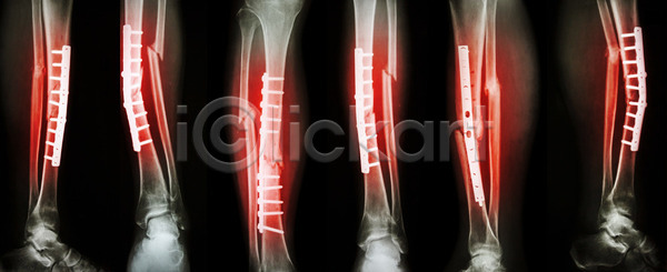 고통 사람없음 JPG 포토 해외이미지 X 건강 검은색 고정 골격 골절 광선 균열 깨짐 나사 내부 돌봄 발목 백그라운드 병원 빨간색 뼈 사건 세트 수술 양발 엑스레이 염증 외과 의사 접시 정형외과 치료 필름 해외202004 해외포토 환자 흰색